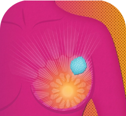 AstraZeneca in breast cancer