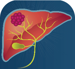 AstraZeneca in liver cancer