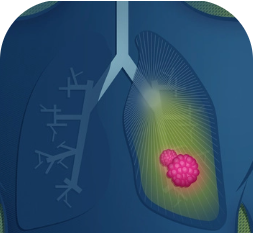 AstraZeneca in lung cancer
