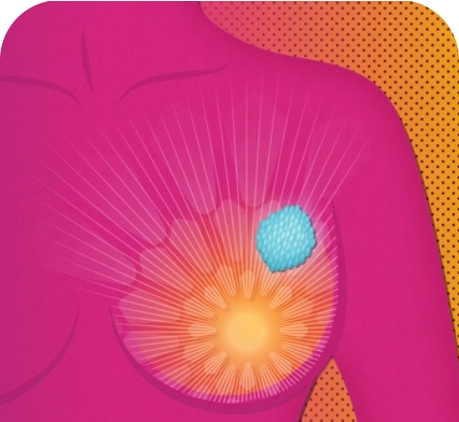 AstraZeneca in breast cancer