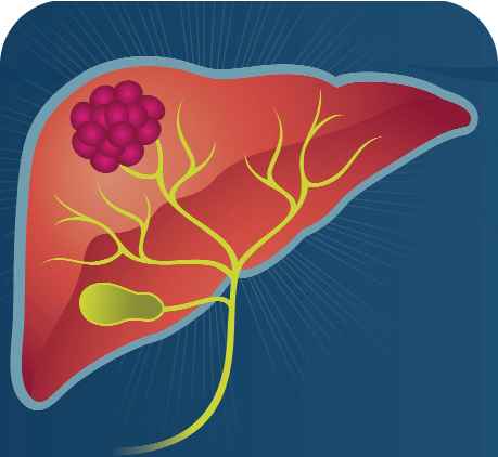 AstraZeneca in liver cancer