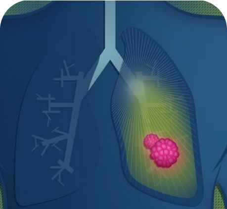 AstraZeneca in lung cancer