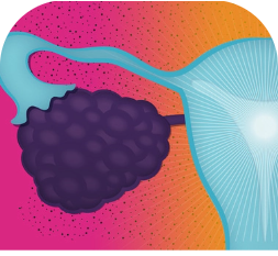 AstraZeneca in ovarian cancer