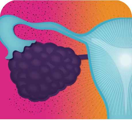 AstraZeneca in ovarian cancer