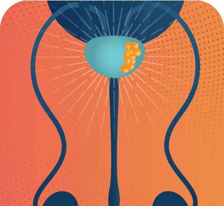 AstraZeneca in prostate cancer